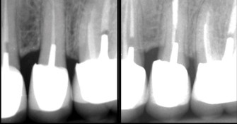 ZOOM CLINIQUE N°3 sur la MICROCHIRUGIE ENDODONTIQUE par Brice Riera